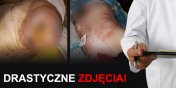 Skandal w elblskim szpitalu! W wypisie byo "stan zadowalajcy", a mama krzyczaa z blu.  [Uwaga drastyczne zdjcia]